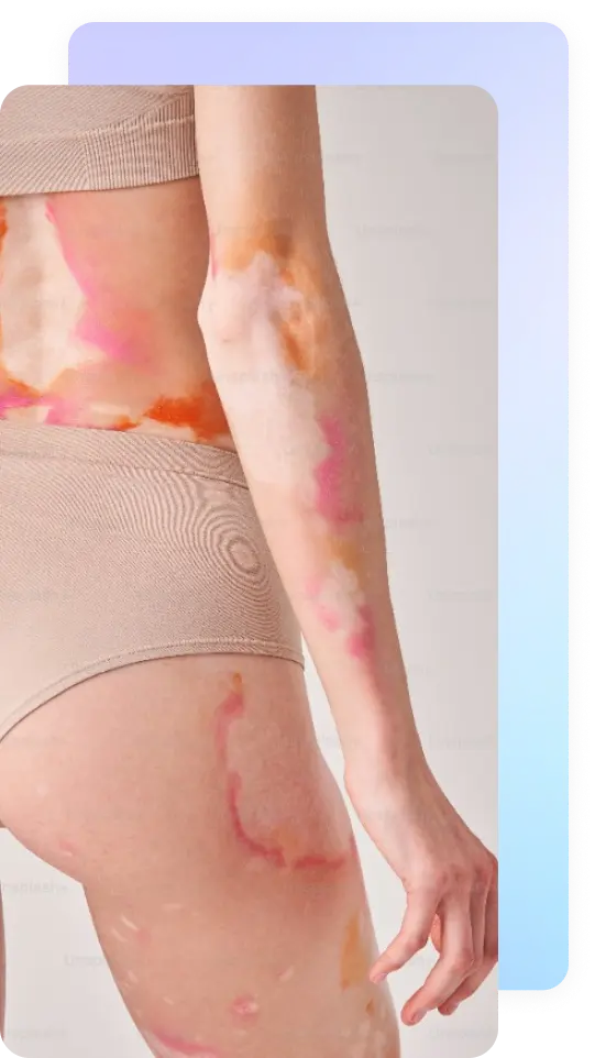 treat-autoimmune-image02